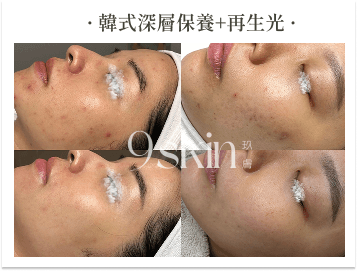 韓式深層保養＋再生光